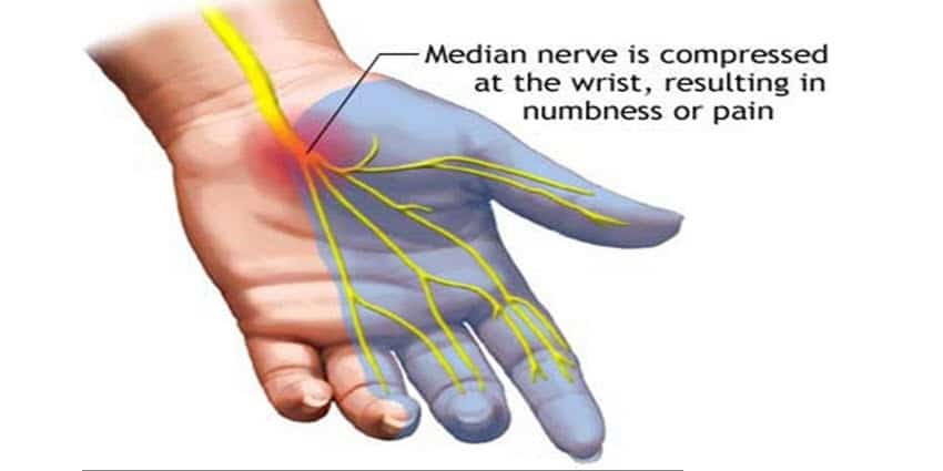 Effective Therapy for Carpal Tunnel Syndrome